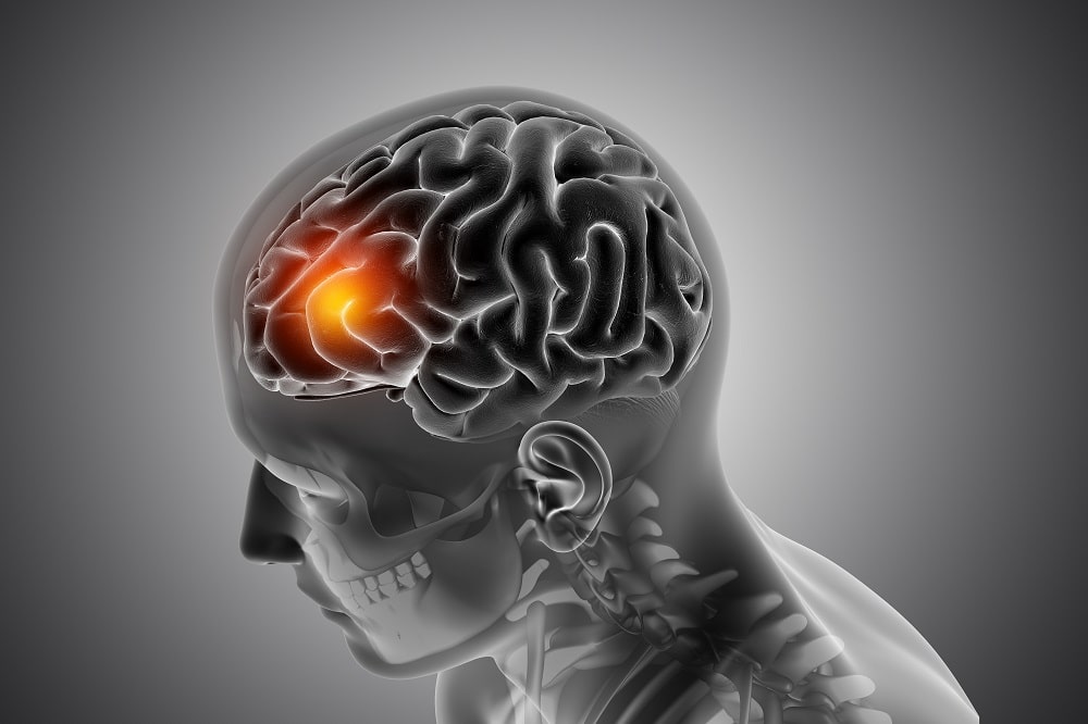 daño-neurologico-cerebro